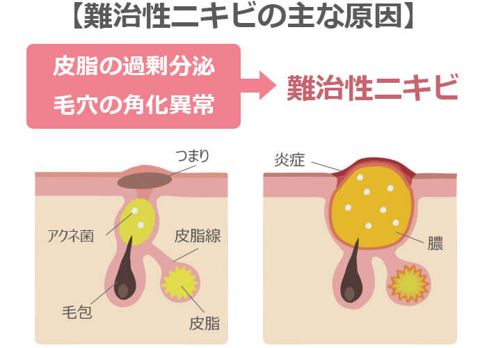 難治性ニキビの主な原因