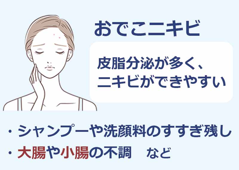 おでこニキビ,皮脂分泌が多くニキビができやすい,シャンプーや洗顔料のすすぎ残し,大腸や小腸の不調など