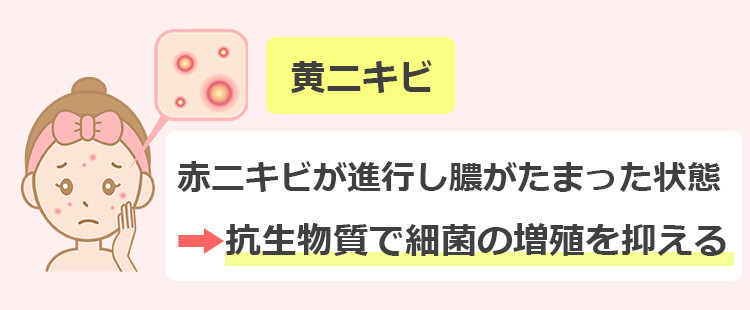 黄ニキビを即効で治す方法