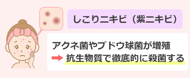 しこりニキビ(紫ニキビ)を即効で治す方法