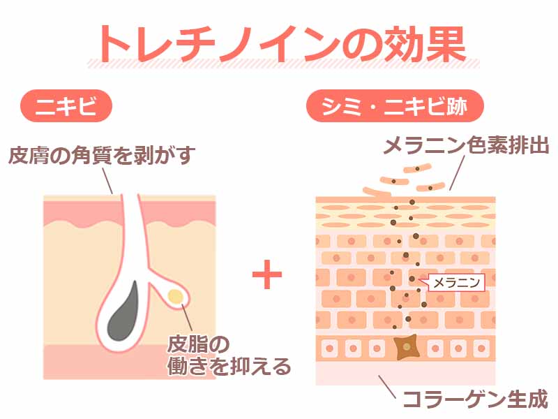 トレチノインの効果