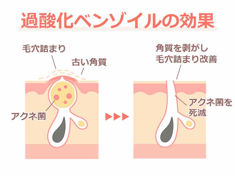 過酸化ベンゾイルの効果