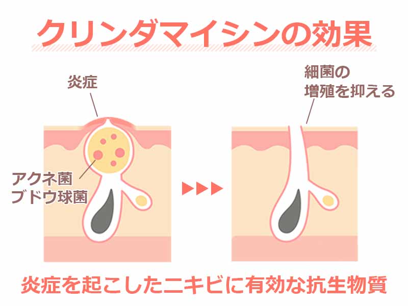 クリンダマイシンの効果